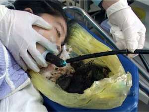 南京6岁女童胃里出现大毛团！当心孩子的异食癖