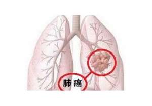 北京市新发恶性肿瘤中肺癌约占20%